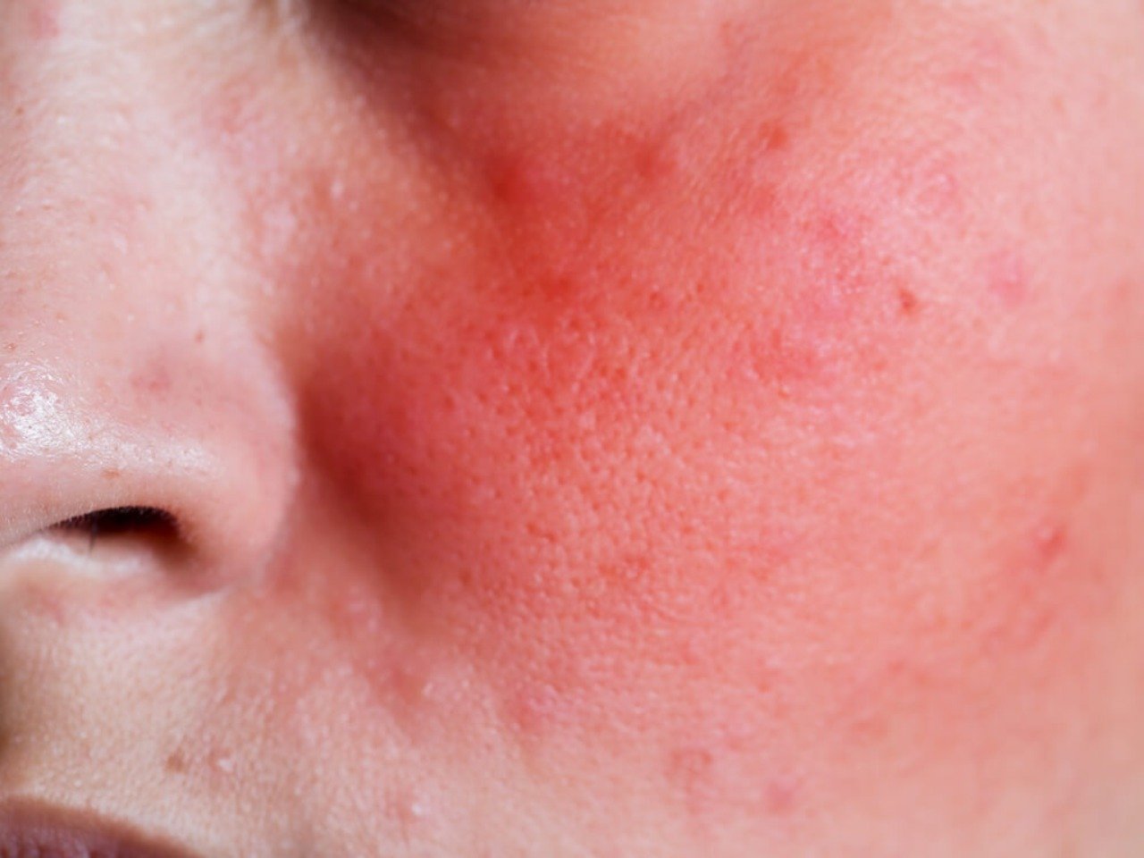 cara menghilangkan kemerahan pada wajah akibat iritasi