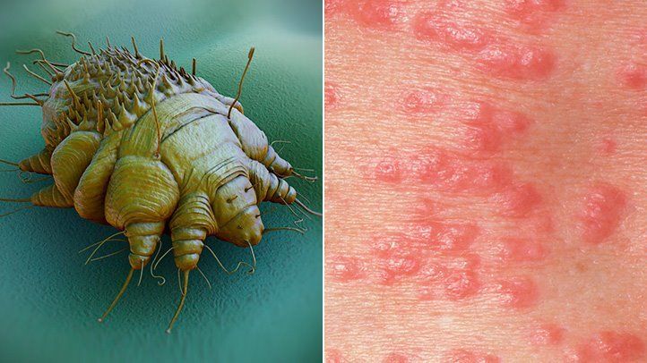 Akibat Scabies atau Akibat Kudis