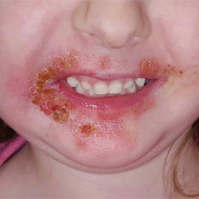 impetigo